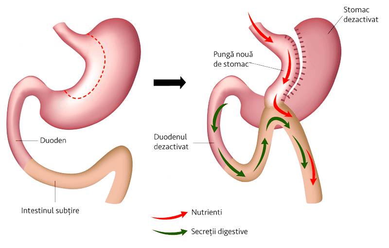MINI GASTRIC BY-PASS